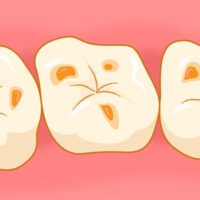 3月4日は「酸蝕歯の日」です!